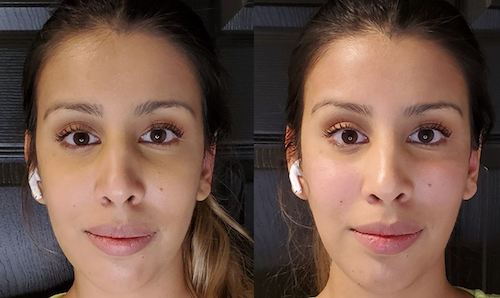 non surgical facelift before after dermal filler lip doctor mississauga oakville